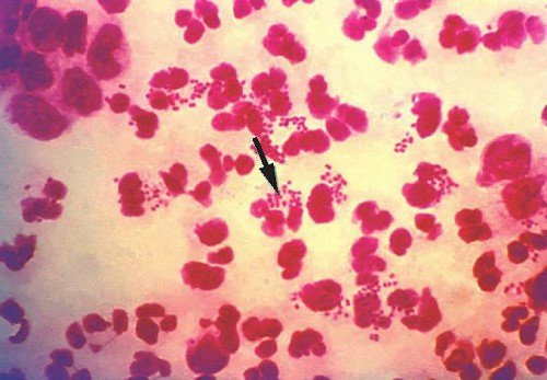 gonorrea