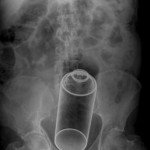 Objetos detectados por los rayos x en el interior del cuerpo