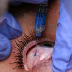 Tatuajes oculares y joyas en la córnea
